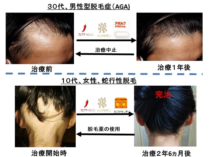 円形脱毛症　病院